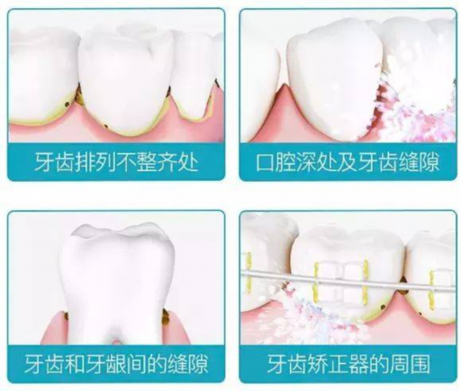 威兰德和国产氧化锆的区别（威兰德臻瓷是二氧化锆吗）(图1)